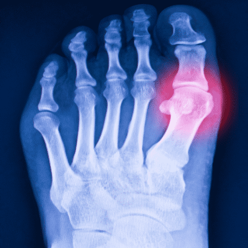 big toe arthritis