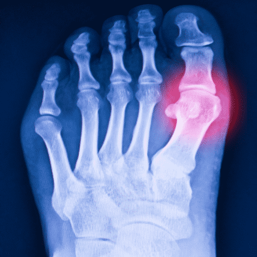 The Most Common Degenerative Diseases Causing Foot Pain