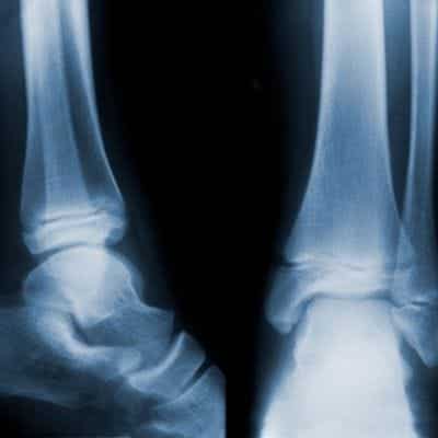 ankle xray