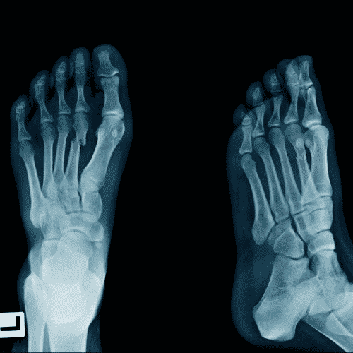 foot fractures