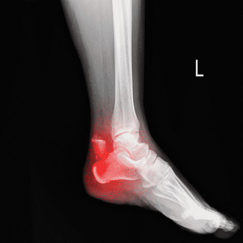 os trigonum syndrome