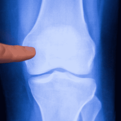 osteochondral lesion