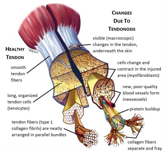 tendon