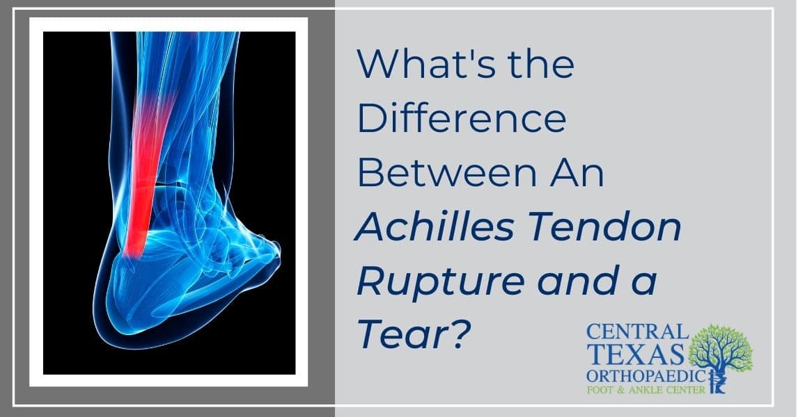 Difference between an Achilles Tendon Rupture and Tear