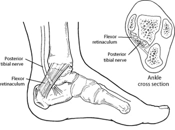 tarsal tunnel syndrome depiction