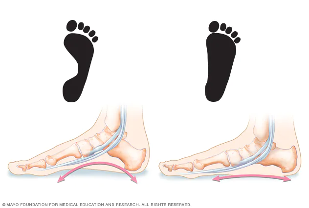 Flat Feet