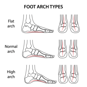 Foot Arch Types